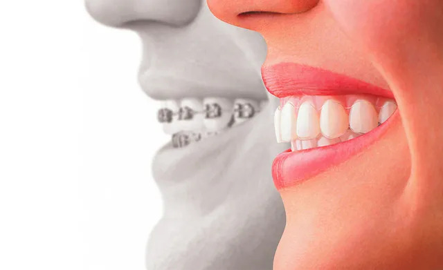 Teeth Aligners | Tower House Dental Clinic